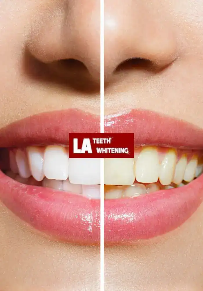 Why Don’t Porcelain and Resin Whiten the Same Way as Enamel Haywards Heath