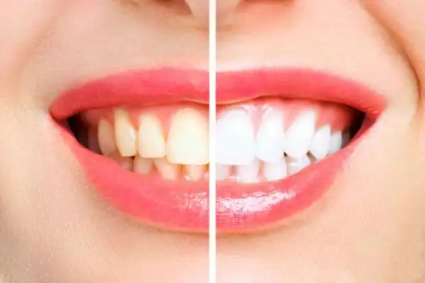 What Are the Common Myths About Laser Teeth Whitening Haywards Heath